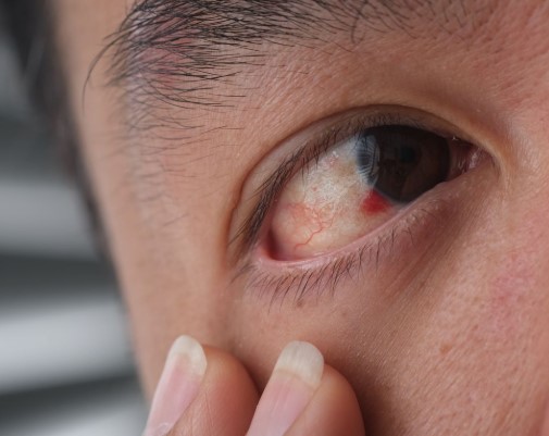 دم في العين