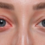 التهاب ملتحمة العين