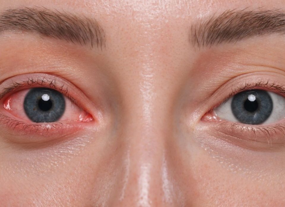 التهاب ملتحمة العين