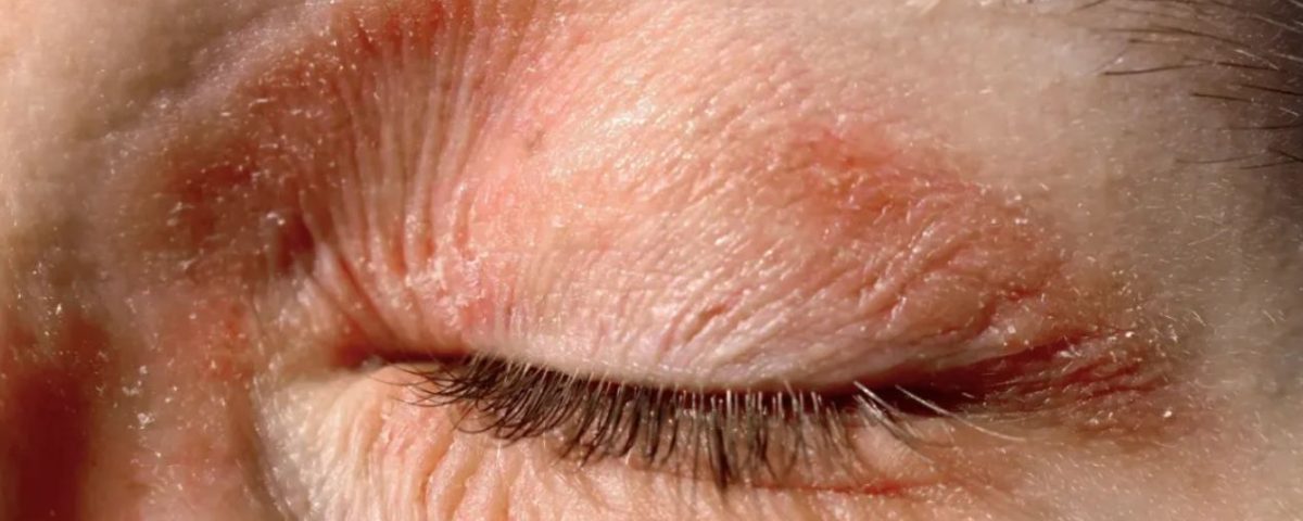 اكزيما العين