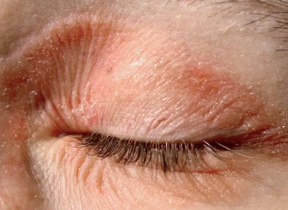 اكزيما العين