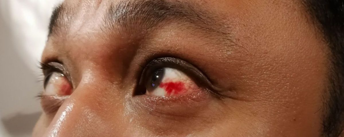 دم في العين