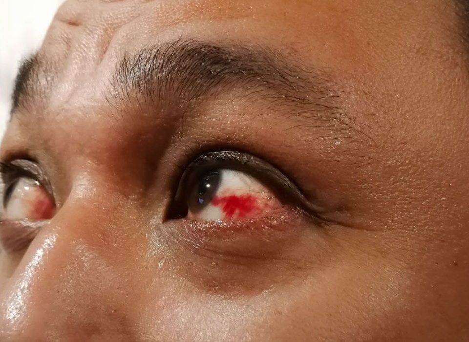 دم في العين