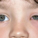 رمد العين عند الاطفال