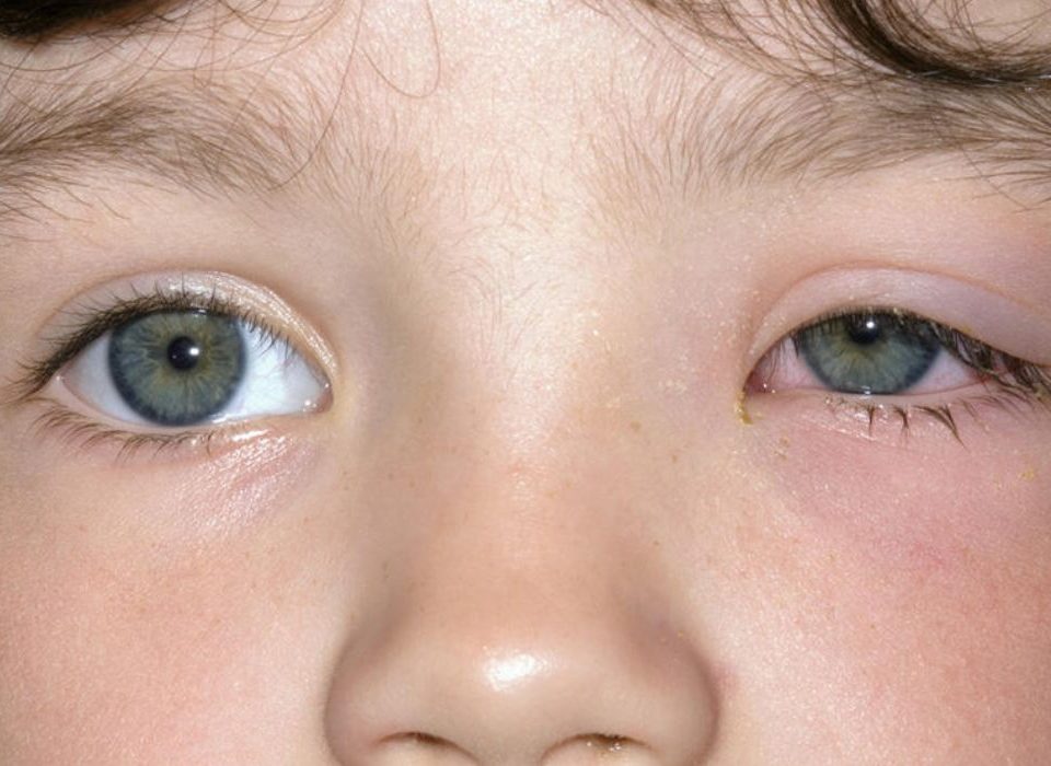 رمد العين عند الاطفال