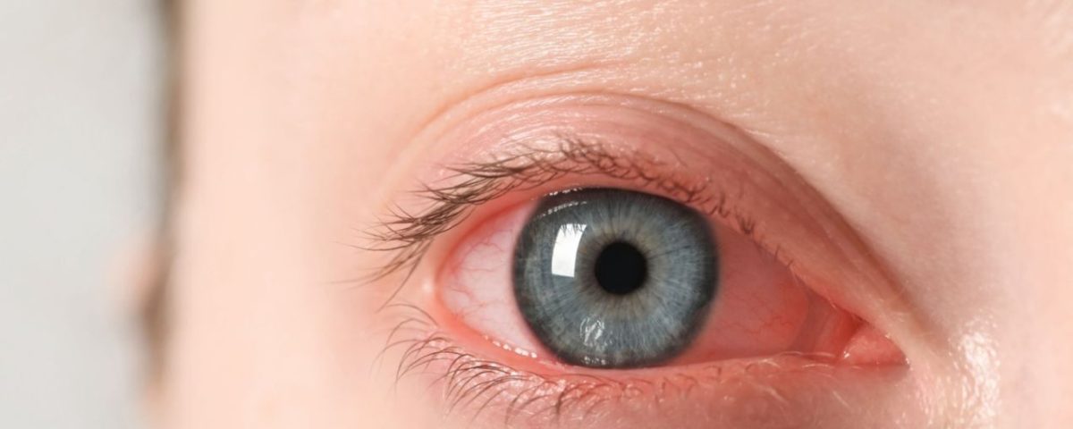 اعراض ارتفاع ضغط العين