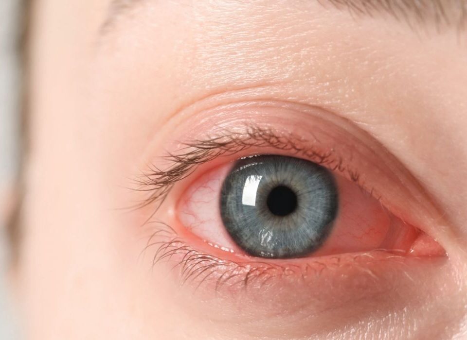 اعراض ارتفاع ضغط العين