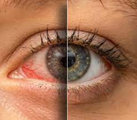 اعراض ارتفاع ضغط العين