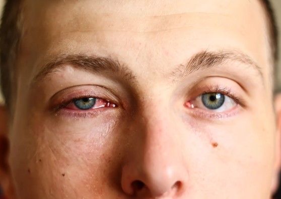 اعراض التهاب العين