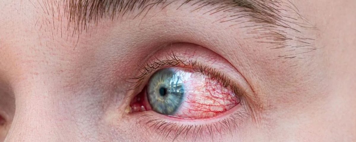 اعراض التهاب العين