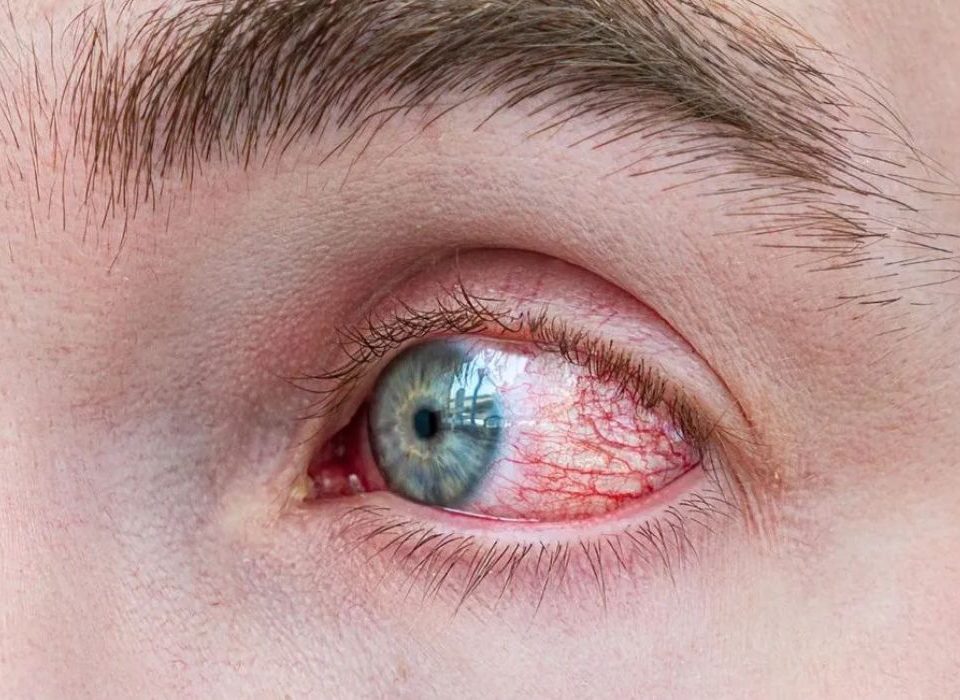 اعراض التهاب العين