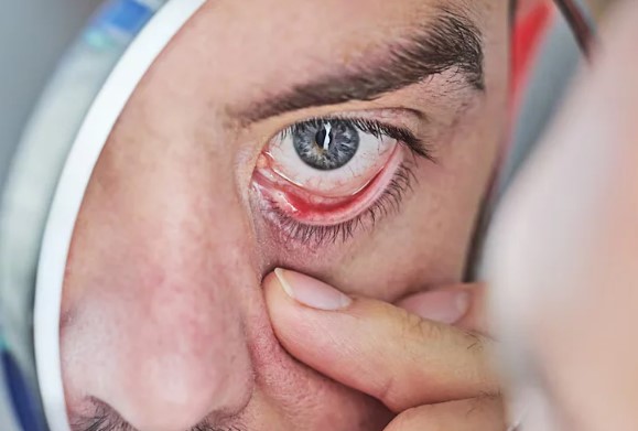 علاج الكيس الدهني في العين 