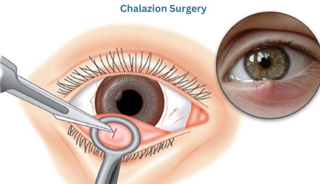 علاج الكيس الدهني في العين 