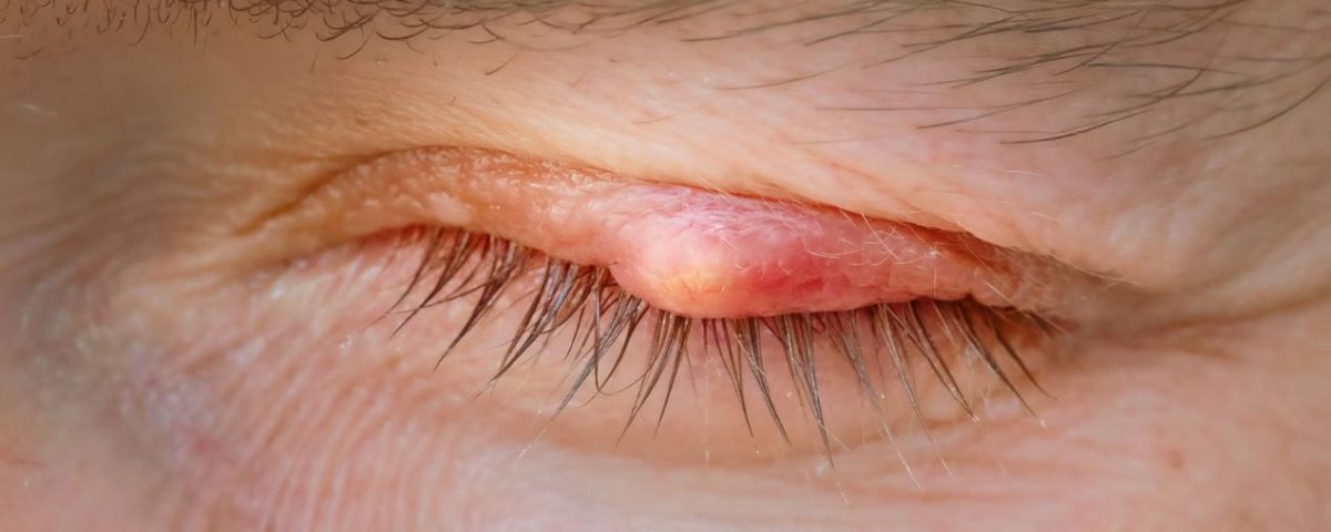 علاج الكيس الدهني في العين