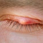 علاج الكيس الدهني في العين