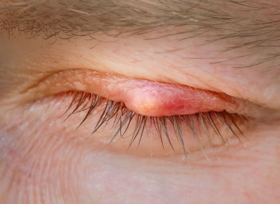 علاج الكيس الدهني في العين