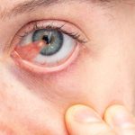 لحمية العين