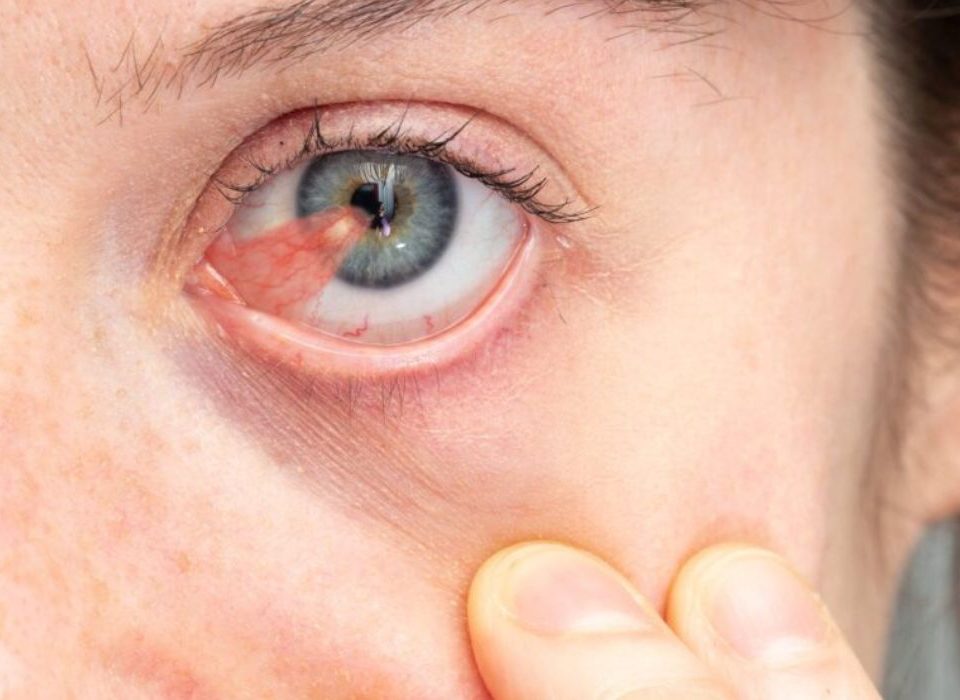 لحمية العين