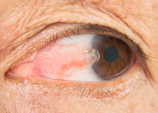 لحمية العين