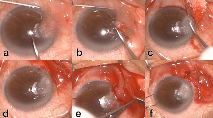 لحمية العين