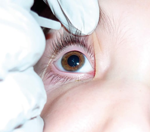 مرهم للعين مضاد حيوي للاطفال