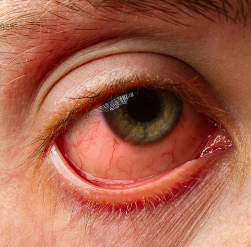 التهاب لحمية العين