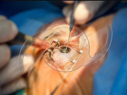 زراعة عدسه للعين