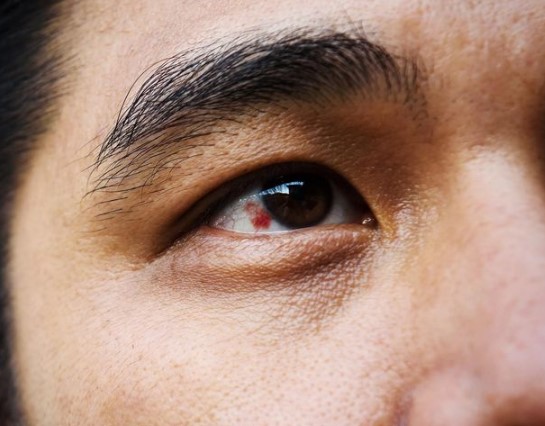 نقطة حمراء بالعين