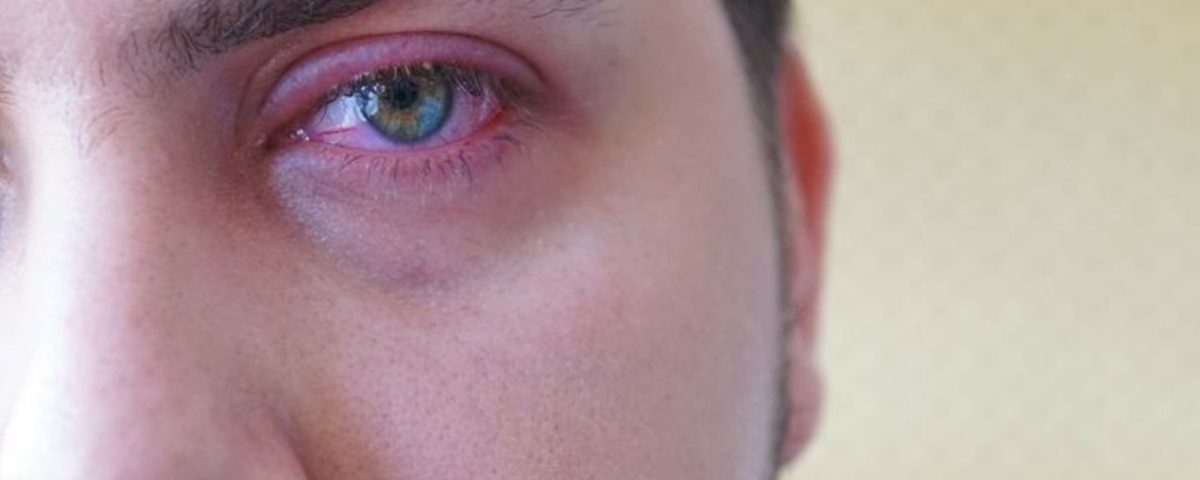 التهاب لحمية العين