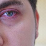 التهاب لحمية العين