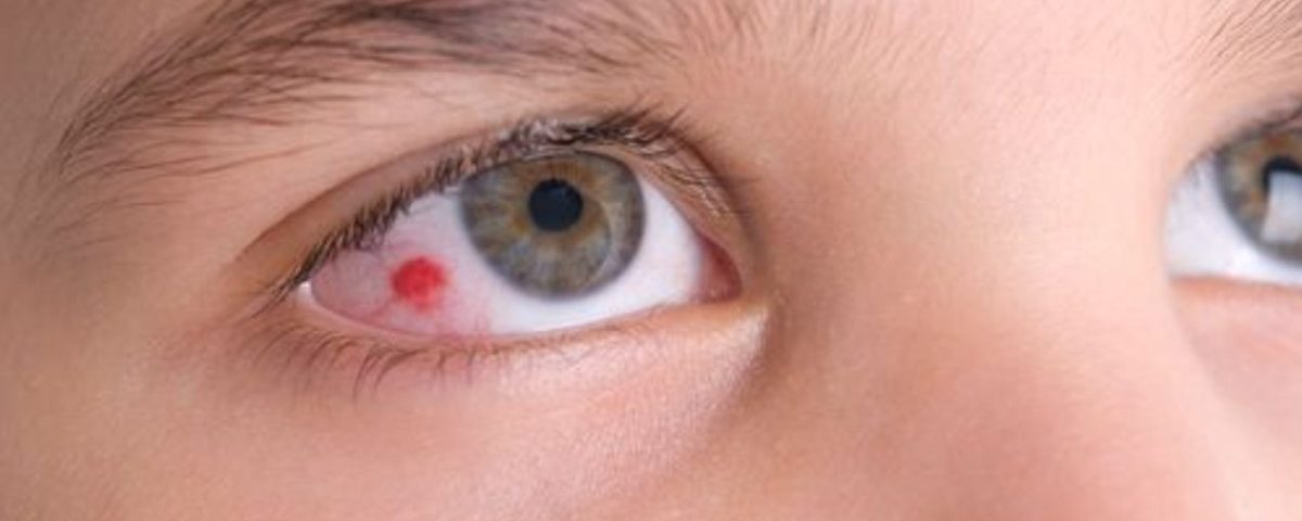 نقطة حمراء بالعين