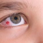 نقطة حمراء بالعين