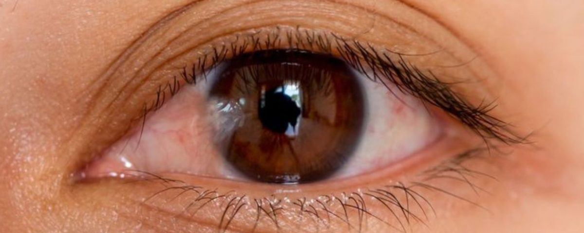 علاج لحمية العين