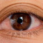 علاج لحمية العين