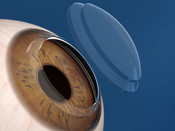 الفرق بين SMILE و LASIK