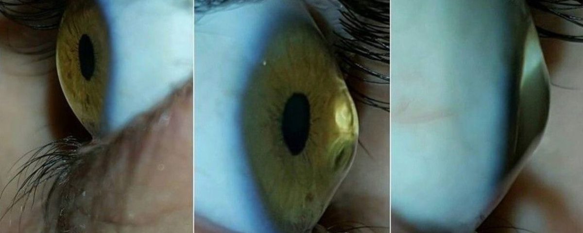 أعراض القرنية المخروطية