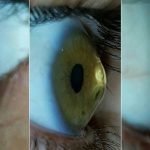 أعراض القرنية المخروطية
