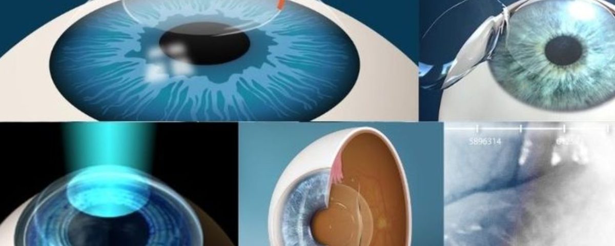 الفرق بين الليزك وPRK وSMILE: أيهما يناسبك؟