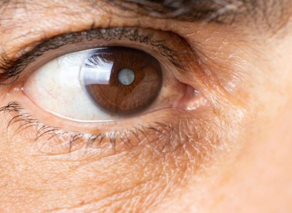 اعراض المياه البيضاء المبكرة